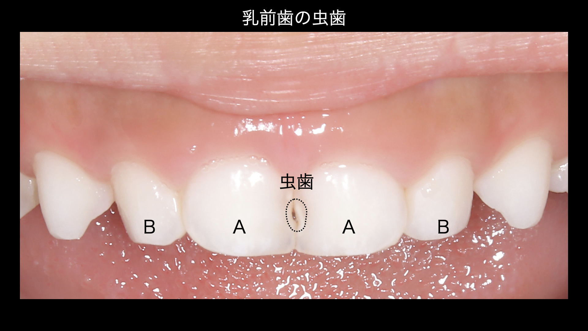 どの乳歯が、むし歯になりやすいの？ | 小児歯科専門サイト