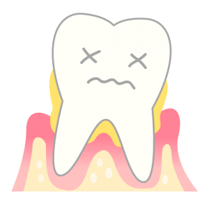 重症の歯周病