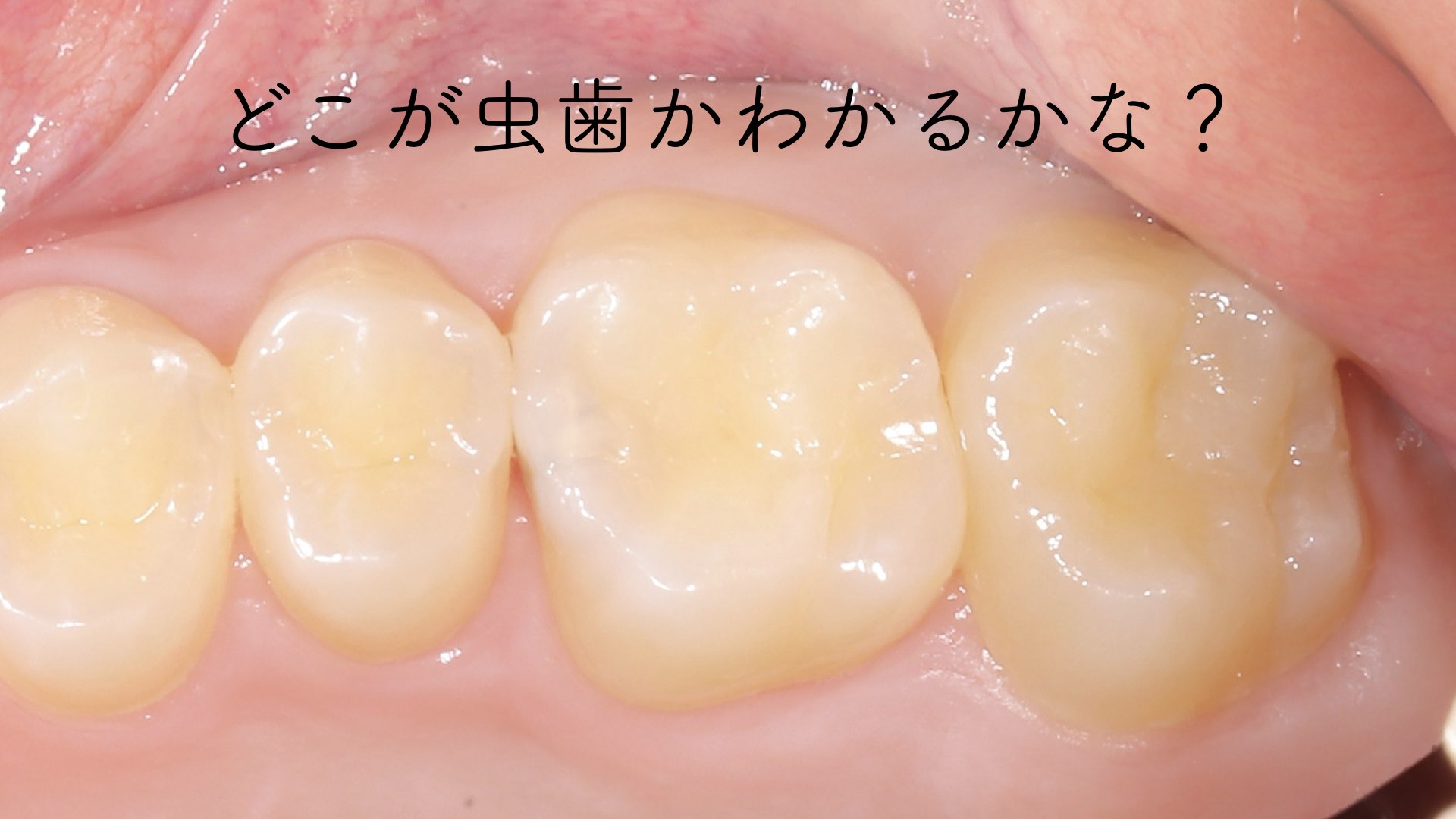 隠れた虫歯