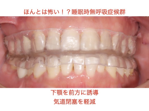 睡眠時無呼吸症候群用マウスピース