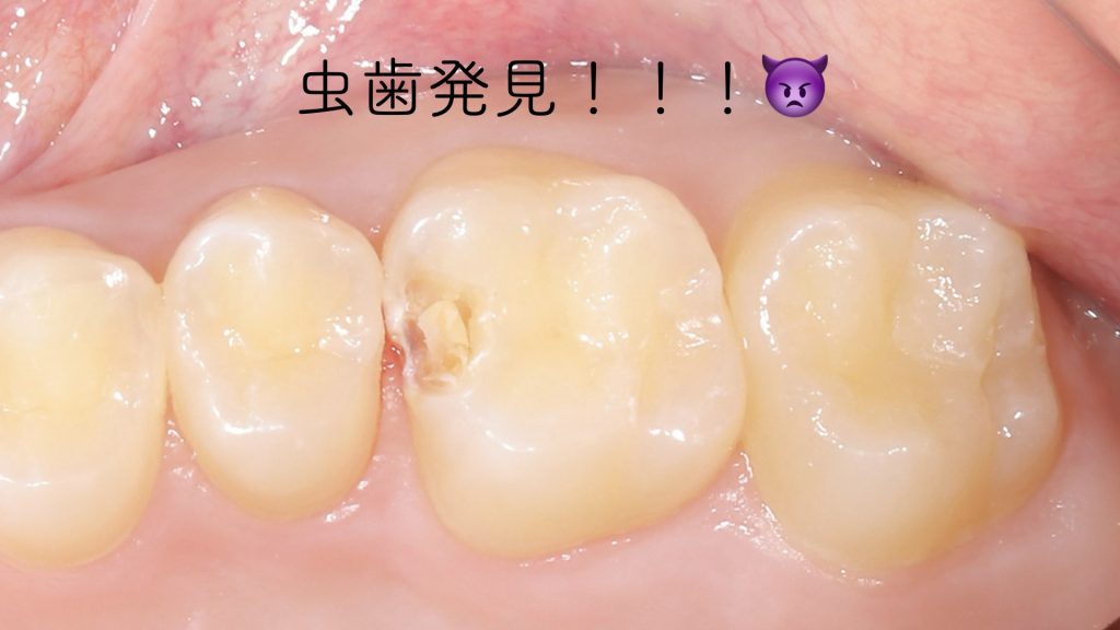 歯間の虫歯